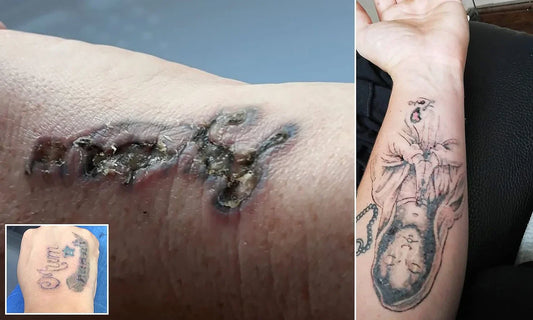 The Hidden Dangers of Laser Tattoo Removal in the US